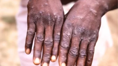 Vaiolo delle scimmie