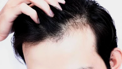I 5 Segni che Anticipano la Calvizie e Come Rallentarne gli Effetti